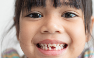 8 Reasons Why Tooth Sealants Help Prevent Cavities