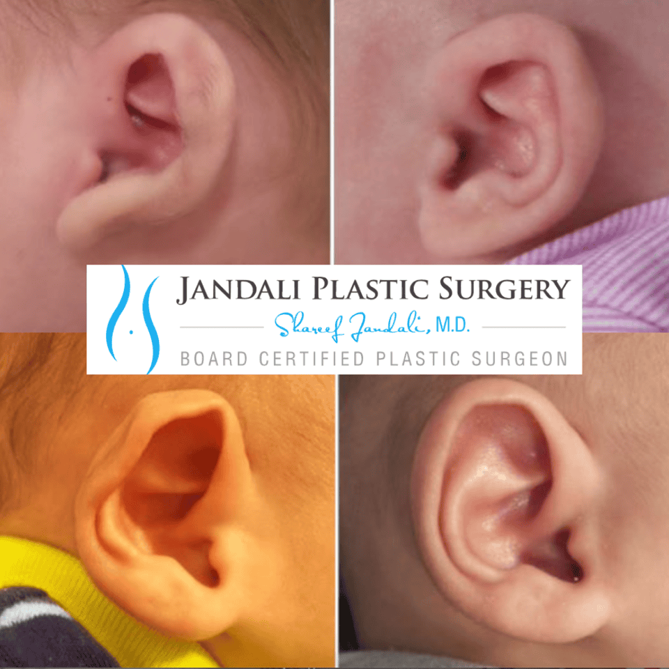 Infant Ear Molding! - Greenwich Moms