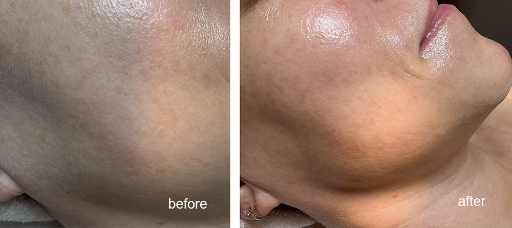 Millennium-dermaplane-before-and-after-1000px