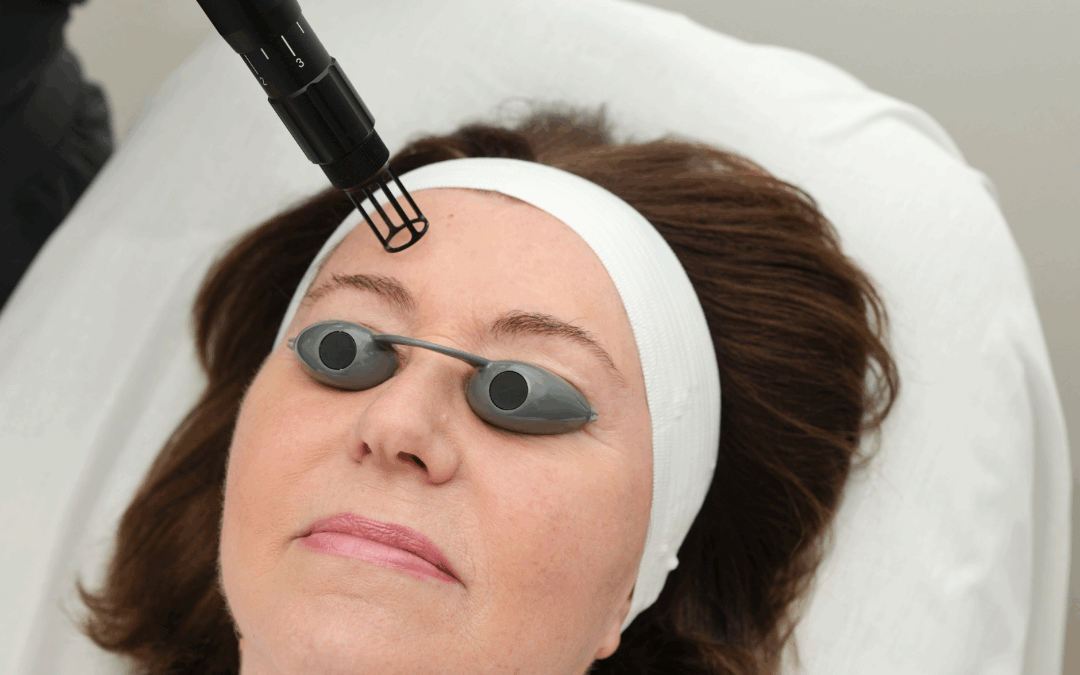 The Erbium Laser Peel: A Skin Reset With Minimal Downtime
