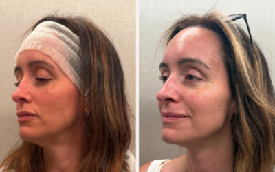 Sofwave Update & My Facial at HerSpace Med Spa!
