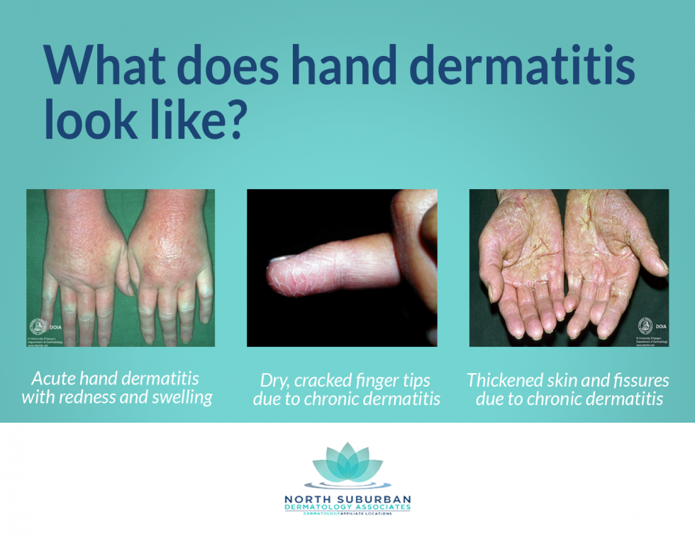 Hand Washing and Hand Dermatitis Tips from Dermatology Associates